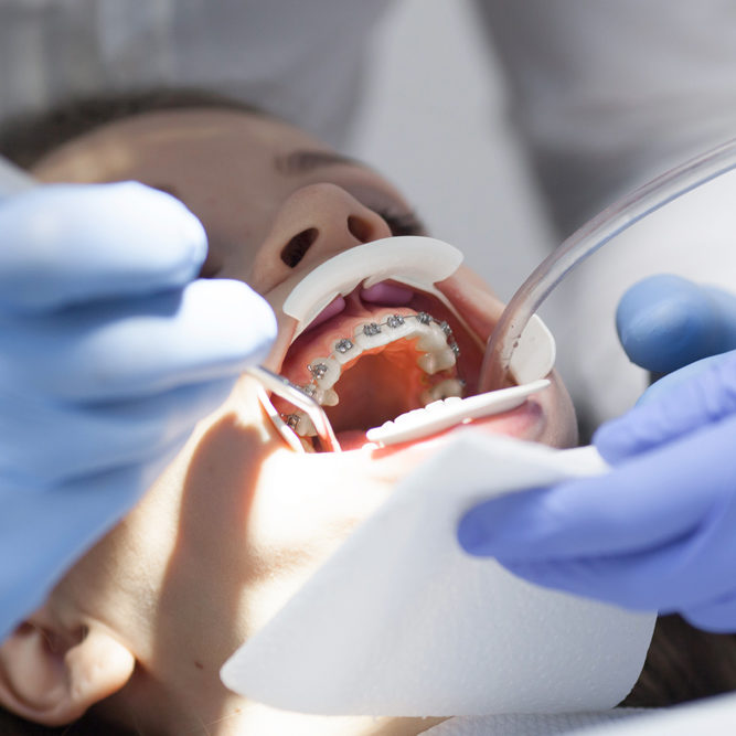 An orthodontist adjusting fixed braces on a patient's upper arch