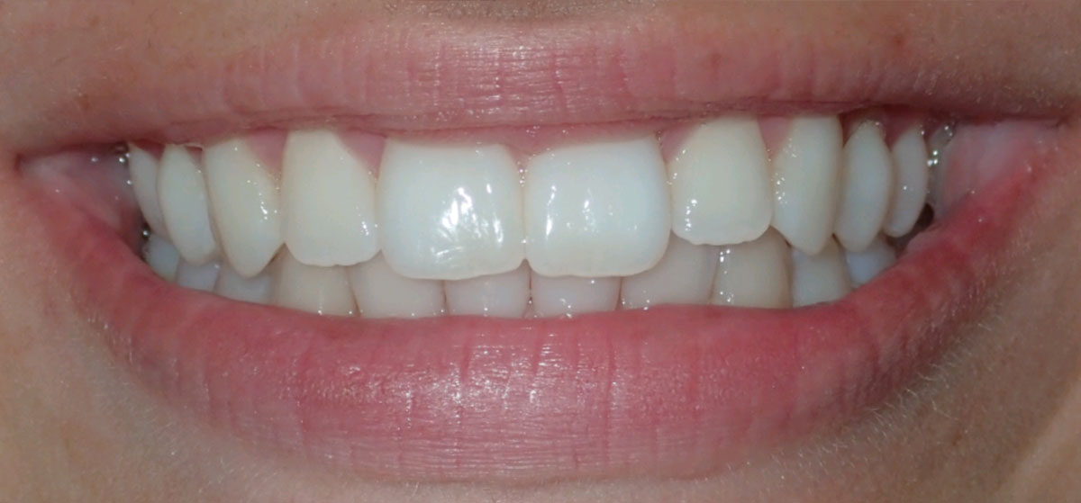 Intraoral photograph of the same patient's bite after orthodontic treatment
