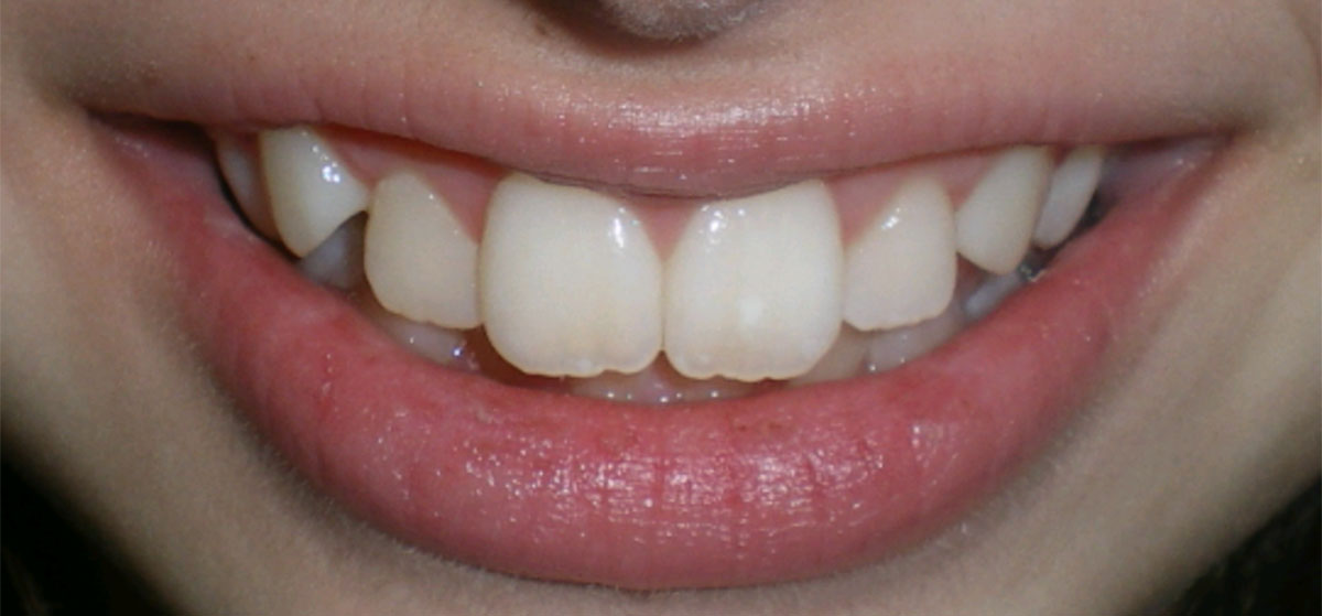 Intraoral photograph of a patient's bite before orthodontic treatment